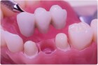 What Is the Most Used Type of Dental Implant?