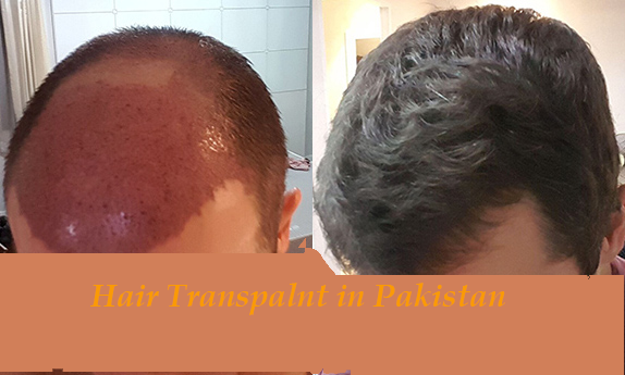 The Success Rate of Hair Transplant Surgery 