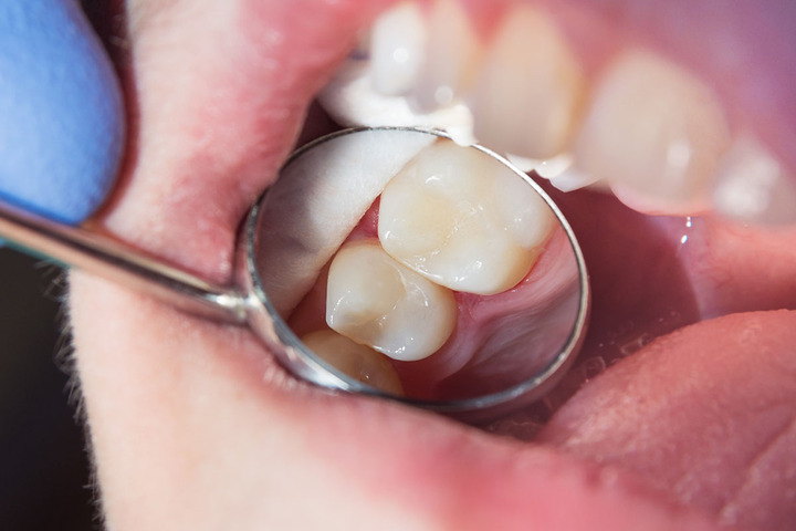 What Can I Do If I Can't Get A Root Canal?
