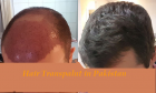 The Success Rate of Hair Transplant Surgery 