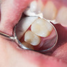 What Can I Do If I Can&#039;t Get A Root Canal?
