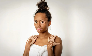 Vitiligo And Skin Cancer Risk: What You Need To Know? - Kayakalp Global