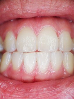 Why Porcelain Veneers Are an Investment in Your Confidence