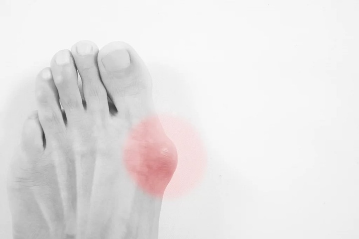 Bunion pain relief