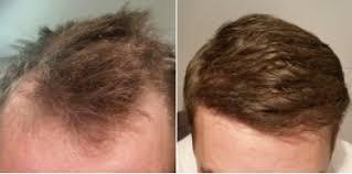 Permanent Hair Restoration Surgery Treatment 