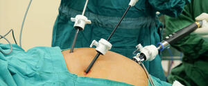 Can Laparoscopic Surgery Treat Gallbladder Stones?