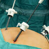 Can Laparoscopic Surgery Treat Gallbladder Stones?