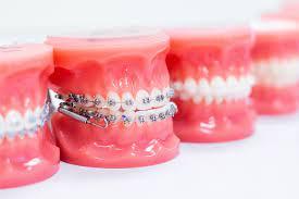 What You Should Know About Dental Implants Procedure?