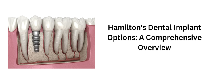 Hamilton's Dental Implant Options: A Comprehensive Overview