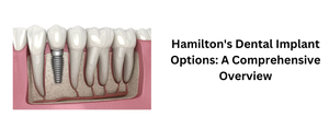 Hamilton&#039;s Dental Implant Options: A Comprehensive Overview