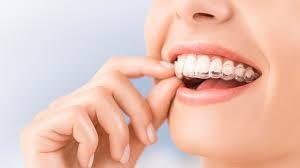 Top 5 Major Benefits of Invisalign