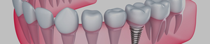 3 Absolute Signs When You Know You Need Dental Implant