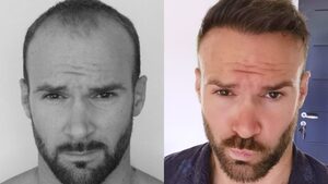 Expert Tips for Choosing the Best Hair Transplant Clinic in Turkey
