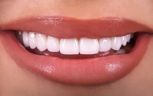 What Are The Steps To Fill Teeth?