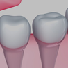 3 Absolute Signs When You Know You Need Dental Implant