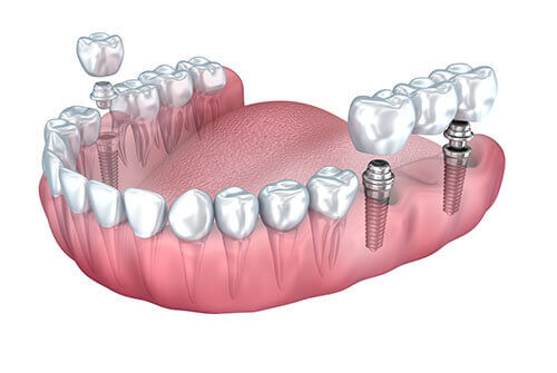 Avail the Benefits of Dental Implants at AK Global Dent