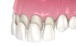 Dental Veneers: Top Important Features They Possess