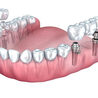 Avail the Benefits of Dental Implants at AK Global Dent