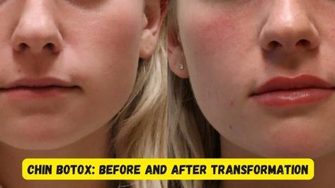 Botox Chin Before and After, Expert Insights