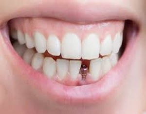 Do Dental Implants Last Longer?