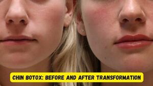 Botox Chin Before and After, Expert Insights