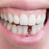 Do Dental Implants Last Longer?
