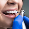 How Long Does Dental Implant Treatment Take?