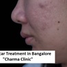 Get an Effective Treatment for Acne Scars at Charma Clinic 
