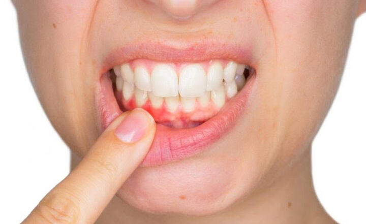 What Exactly Is A Tooth Abscess?