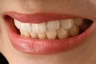 Caring for Your Porcelain Veneers: Tips for Long-Lasting Results