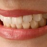 Caring for Your Porcelain Veneers: Tips for Long-Lasting Results