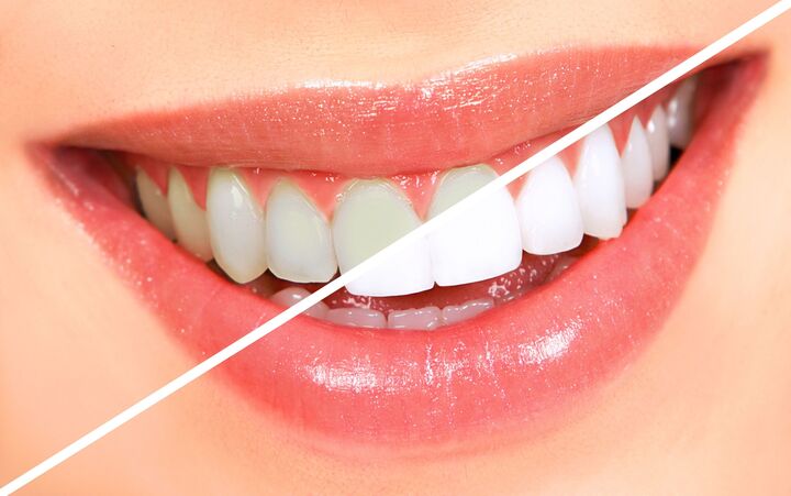 How Do You Fight Against Tooth Decay?
