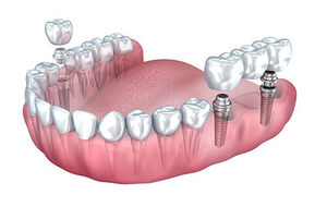 Get Dental Implants at Gurgaon\u2019s Best Dental Speciality Clinic: A K Global Dental