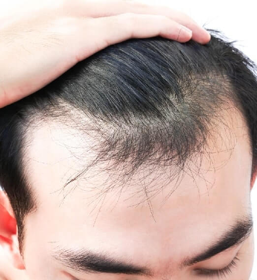 Avail the Benefits of Hair Transplant at Charma Clinic