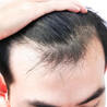 Avail the Benefits of Hair Transplant at Charma Clinic