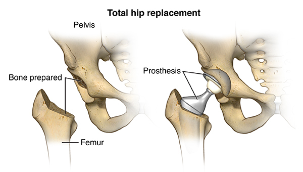 Hip Replacement Surgery: A Patient's Perspective