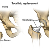 Hip Replacement Surgery: A Patient&#039;s Perspective