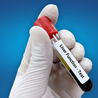 SGPT Liver Blood Tests- Its normal &amp; high range, causes and symptoms