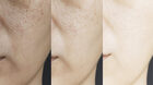 Maximizing Results: The Benefits of Acne Scar Laser Treatment