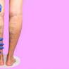 How Does Sclerotherapy Help Eliminate Spider Veins?