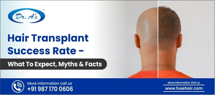 Hair Transplant Success Rate – What To Expect, Myths and Facts