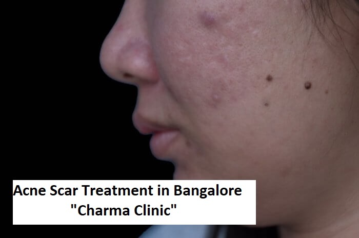 Get The Best Acne Scar Treatment in Bangalore at Charma Clinic