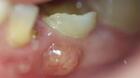 Is Composite Filling Good For Teeth?