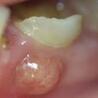 Is Composite Filling Good For Teeth?