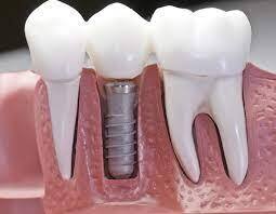 What Role Do Dentures Play In Dentistry?