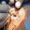Best Eye Hospital for Phacoemulsification Surgery in Delhi