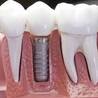 What Role Do Dentures Play In Dentistry?