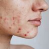 Clear Skin Ahead: Best Acne Scar Treatments in Manhattan