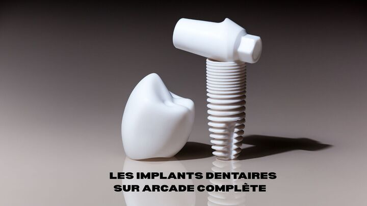 Quels sont les implants dentaires sur arcade complète ?