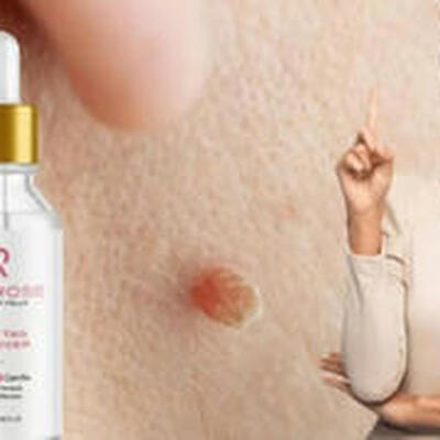 Perfect Skin Tag Remover